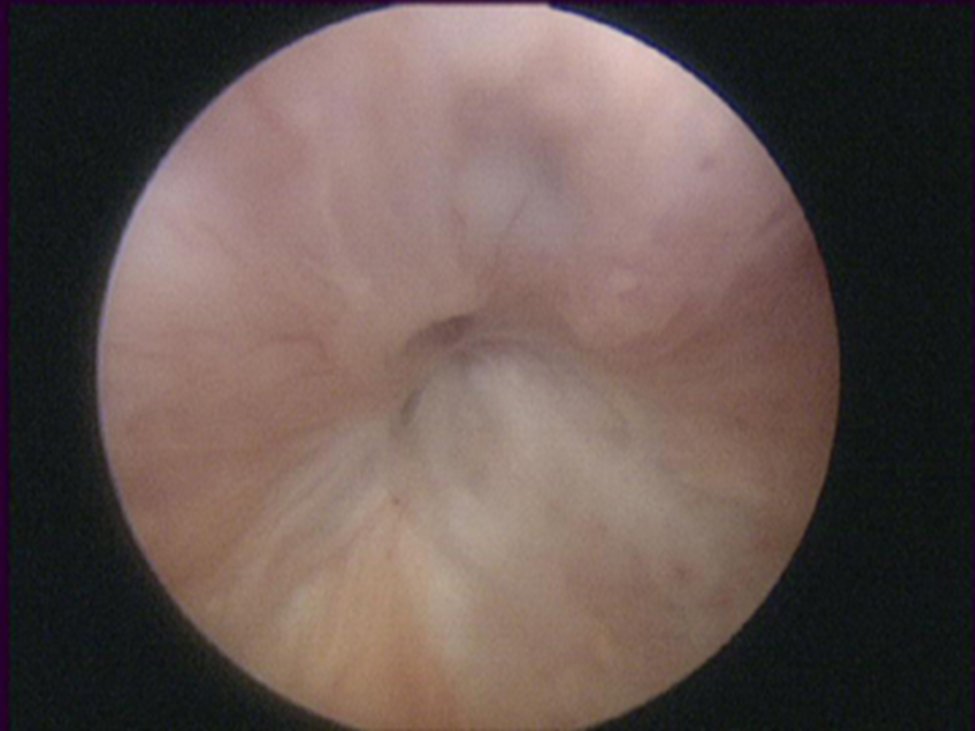 Urology Gold Journal (@urogoldjournal) on Twitter photo GOLD CHALLENGE
73yo male with recurrent bladder neck contracture after multiple TUIBNCs. PVR 252 cc, CIC dependent. Cystoscopy shown below. Best next step?
<a href="/urogoldjournal/">Urology Gold Journal</a> <a href="/JillC_Buckley/">Jill C. Buckley</a> <a href="/Dhruv_Puri_/">Dhruv Puri</a>
goldjournal.net/article/S0090-… GOLD CHALLENGE
73yo male with recurrent bladder neck contracture after multiple TUIBNCs. PVR 252 cc, CIC dependent. Cystoscopy shown below. Best next step?
<a href="/urogoldjournal/">Urology Gold Journal</a> <a href="/JillC_Buckley/">Jill C. Buckley</a> <a href="/Dhruv_Puri_/">Dhruv Puri</a>
goldjournal.net/article/S0090-…