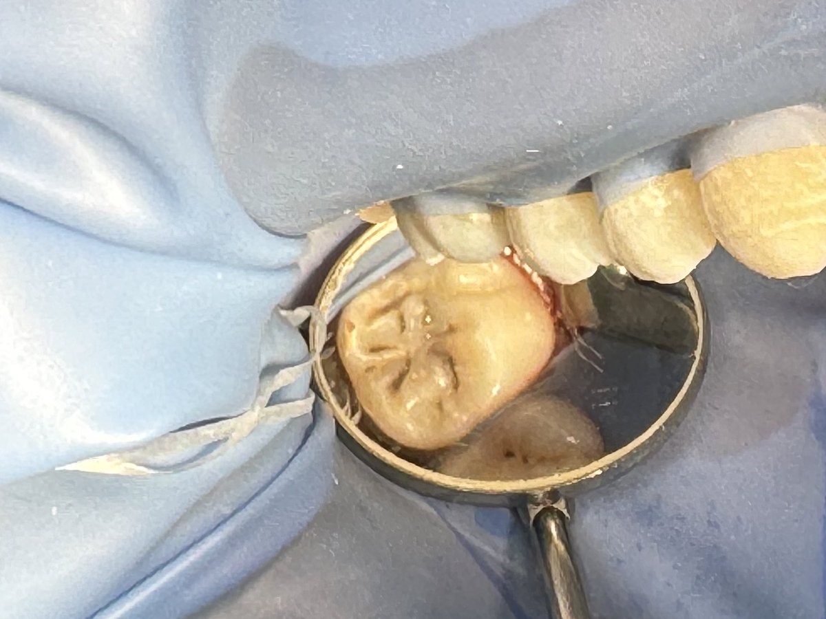 This week's accomplishment ☺️

Class I restoration on #16 &amp; #17 + fissure sealant on #16