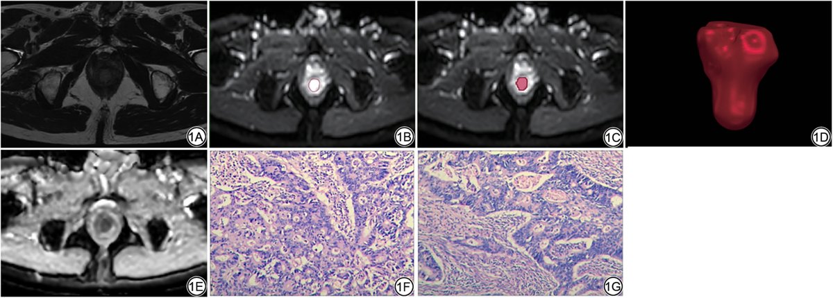 CJMRI_2010's tweet photo. The full volume quantitative parameters of #IVIM can reflect the pathological characteristics of rectal adenocarcinoma to a certain extent, and can be used as an imaging index for preoperative assessment of the biological behavior of rectal adenocarcinoma.
https://t.co/8CrgiURtei https://t.co/zeGzDueIZH