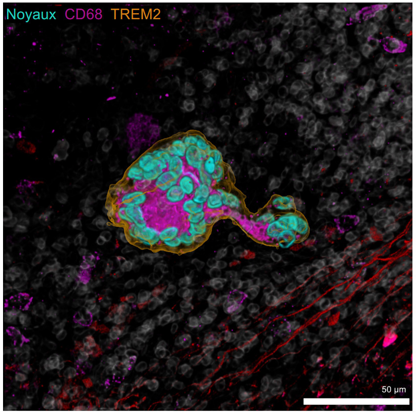 GustaveRoussy's tweet photo. 📰 Cancer Discovery - Découverte d’un nouveau biomarqueur pronostique dans les carcinomes épidermoïdes ORL.

Jusqu’alors, la présence de macrophages exprimant TREM2 dans une tumeur était associée à un mauvais pronostic.

Les travaux menés au sein du laboratoire du Pr Florent Ginhoux par Grégoire Gessain, interne en pathologie à @GustaveRoussy, démontrent que dans le cas des carcinomes épidermoïdes ORL, la présence d’un type particulier de cellules immunitaires – des macrophages géants exprimant TREM2 – est un facteur de bon pronostic. Ce nouveau biomarqueur pourrait à terme aider les oncologues à personnaliser la prise en charge des patients.

Lire le communiqué de presse ➡ https://t.co/7yPX8TfGH0