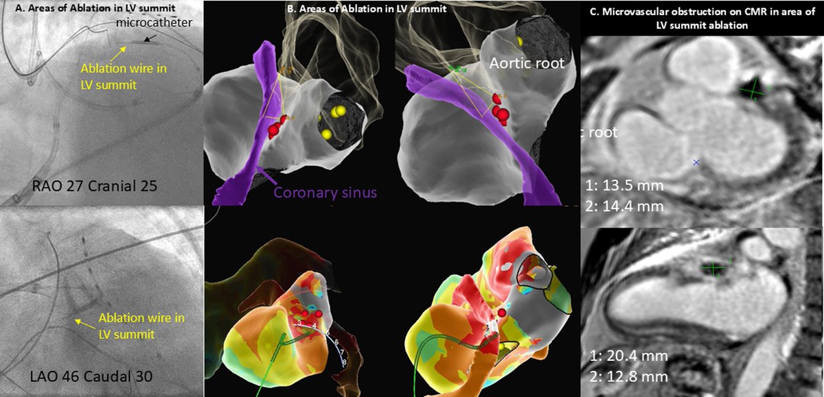 Heart Rhythm Case Reports (@hrs_casereports) on Twitter photo Ventricular Intramyocardial Navigation for Tachycardia Ablation Guided by Electrograms (VINTAGE) for Left Ventricular Summit Arrythmia in a Human
<a href="/danealson/">Neal Kumar Bhatia</a>
heartrhythmcasereports.com/article/S2214-… Ventricular Intramyocardial Navigation for Tachycardia Ablation Guided by Electrograms (VINTAGE) for Left Ventricular Summit Arrythmia in a Human
<a href="/danealson/">Neal Kumar Bhatia</a>
heartrhythmcasereports.com/article/S2214-…