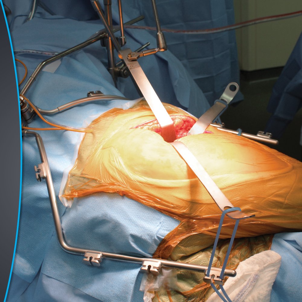 ThompsonRetract's tweet photo. The Thompson Hip System offers consistent, reproducible exposure and is a game-changer for outpatient total hip arthroplasties. Cost-effective, space-saving, and efficient—it’s a must-have in any OR!

#ThompsonRetractor #HipSurgery #OutpatientTHA #SurgicalInnovation https://t.co/RfoIqw6sZF