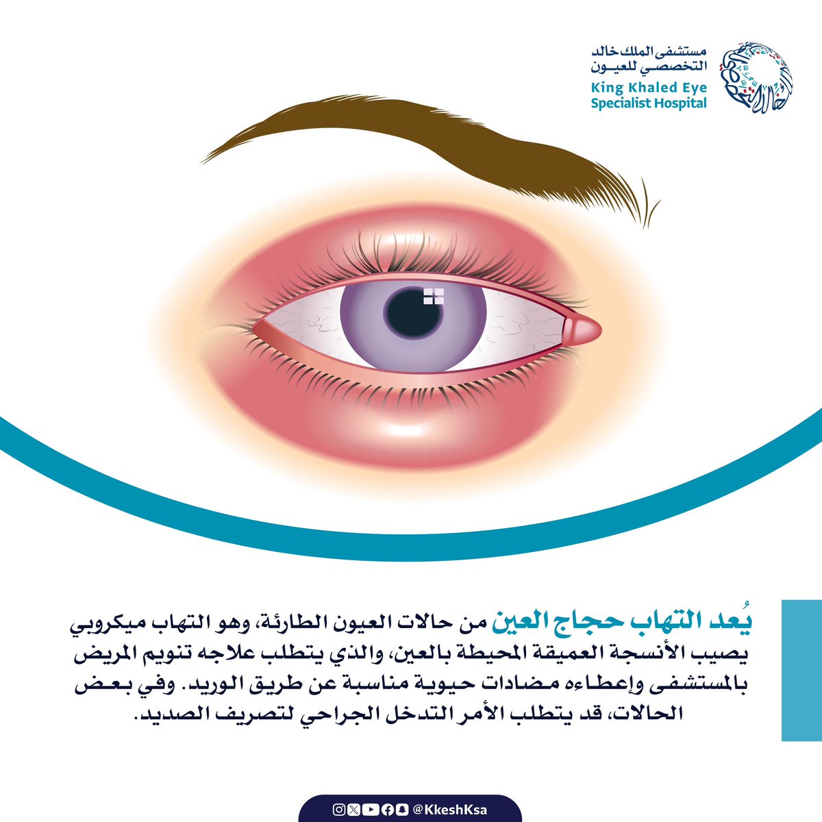 KKESHKSA's tweet photo. التهاب حجاج العين..
حالة طبية طارئة ..

#أنتم_بالعيون https://t.co/AGZuOuQlE3