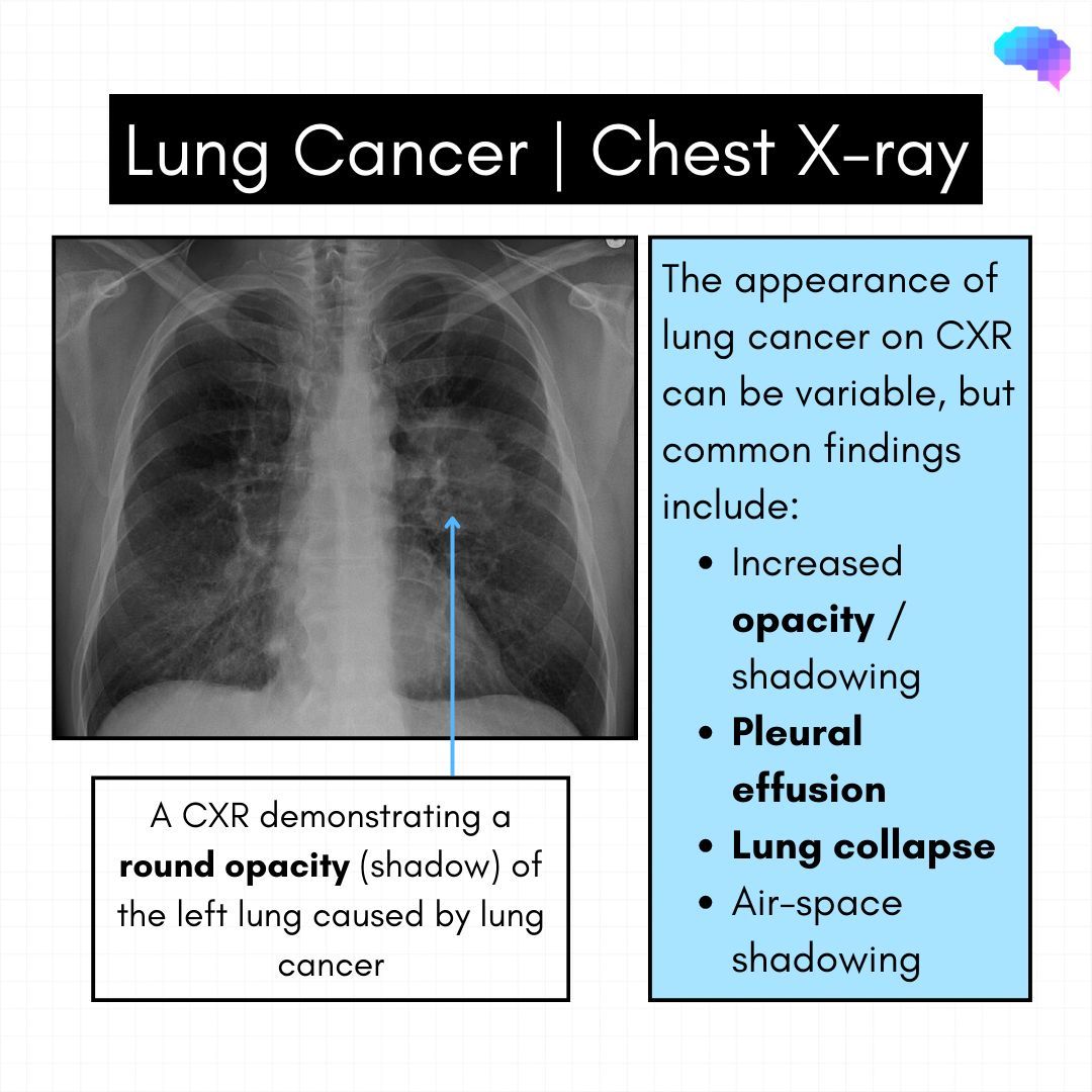 Interpreting chest X-rays is an essential skill for clinical practice that is frequently assessed in OSCEs. Specific CXR findings and abnormalities commonly appear in OSCEs, such as lung cancers. 

#geekymedics #FOAMed #MedTwitter #MedX #MedStudentTwitter