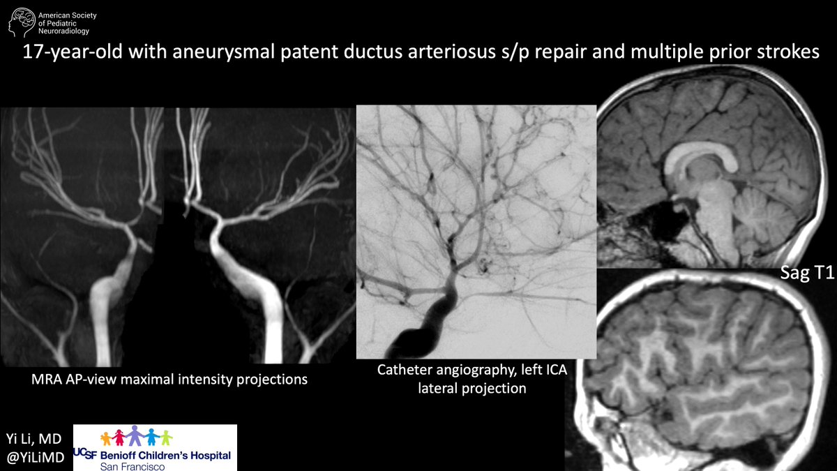 Case of the week: 17-year-old with aneurysmal patent ductus arteriosus s/p repair and multiple prior strokes bit.ly/4ef5FeA Yi Li, MD, UCSF Benioff Children's Hospital #PediNeuroRad #MedEd #FOAMrad #PedsRad