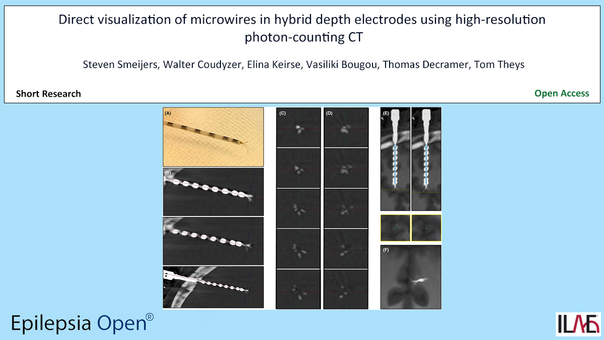 EpilepsiaOpen's tweet photo. Direct visualization of microwires in hybrid depth electrodes using high-resolution photon-counting CT
https://t.co/sD2bCLNgqa
#epilepsy #ILAE #BehnkeFriedelectrode #hybriddepthelectrodes #microelectrodes #photoncountingCT #PCCT #visualization @IlaeWeb @WileyNeuro https://t.co/dLgPGAj1yj