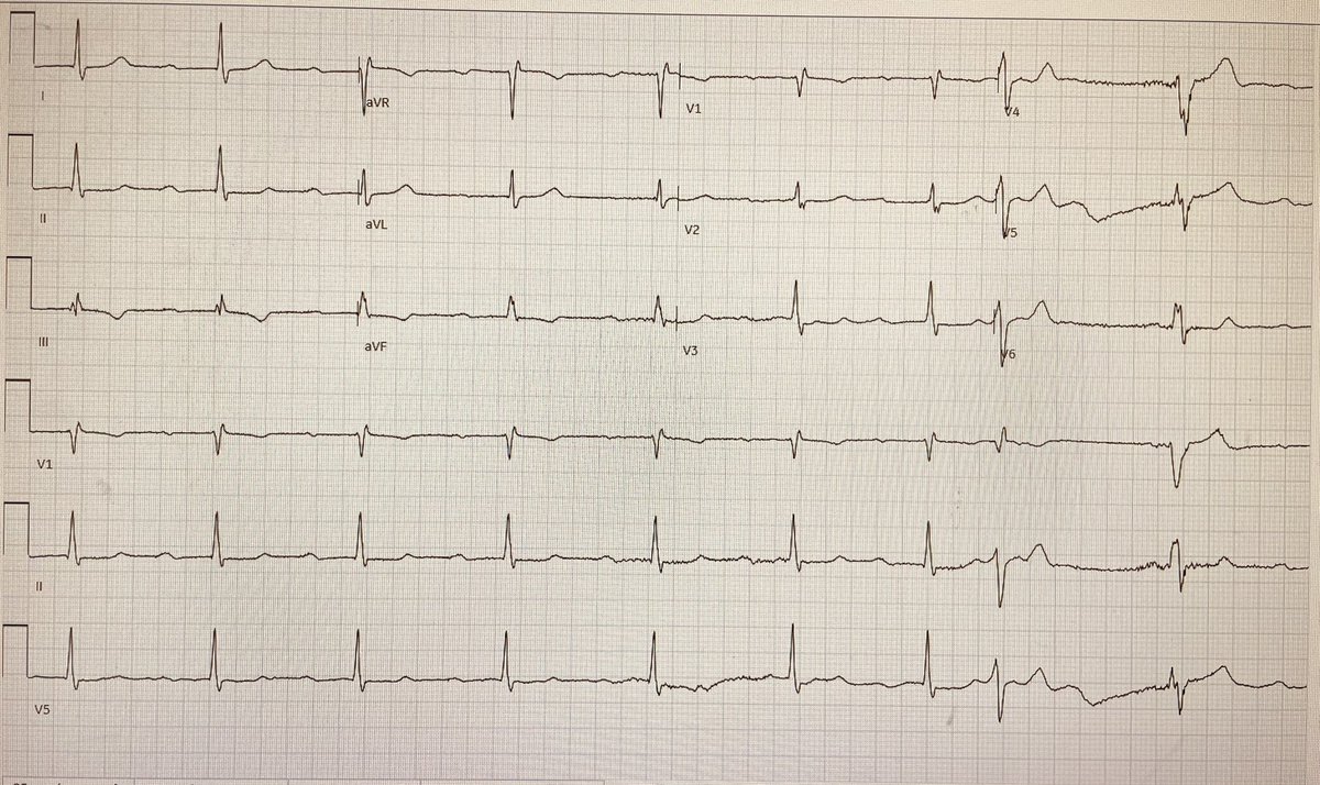 David Didlake (@didlakedw) on Twitter photo Mid 60’s M, Hx CABG, EF 45 and stable. No symptoms. ECG1 6 months ago (regular follow-up). ECG2 most recent. #ECG #CardioTwitter #MedTwitter <a href="/Arron_Pearce_/">Arron Pearce</a> Mid 60’s M, Hx CABG, EF 45 and stable. No symptoms. ECG1 6 months ago (regular follow-up). ECG2 most recent. #ECG #CardioTwitter #MedTwitter <a href="/Arron_Pearce_/">Arron Pearce</a>