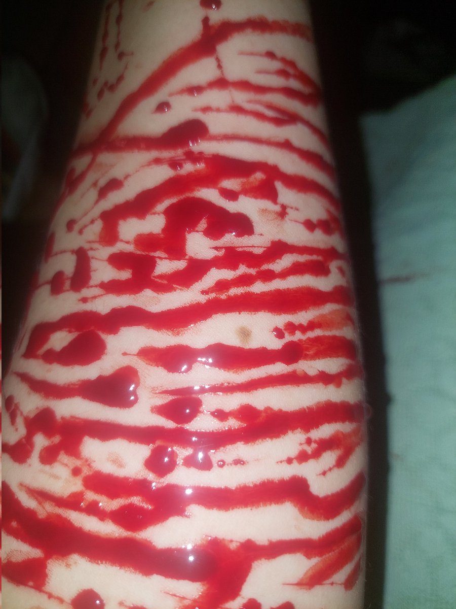 Hrnydollo's tweet photo. I miss relapsing on my arm eugh
(IM GONNA CRY THEYRE TOO SMALL IN MY EYES IM SO EMBARRASSED)

#shtwt #slittwt #sh #self_harm https://t.co/aZPNmYH3mU