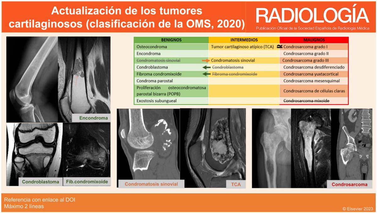 SERAM - Sociedad Española de Radiología Médica (@seram_rx) on Twitter photo Los tumores cartilaginosos son un grupo amplio y heterogéneo de neoplasias
Descubre todas sus características en este artículo de la <a href="/RevistaRADIOLO2/">@RevistaRADIOLOGIA</a>🔗 elsevier.es/es-revista-rad…
Link to the english version🔗 elsevier.es/en-revista-rad… Los tumores cartilaginosos son un grupo amplio y heterogéneo de neoplasias
Descubre todas sus características en este artículo de la <a href="/RevistaRADIOLO2/">@RevistaRADIOLOGIA</a>🔗 elsevier.es/es-revista-rad…
Link to the english version🔗 elsevier.es/en-revista-rad…