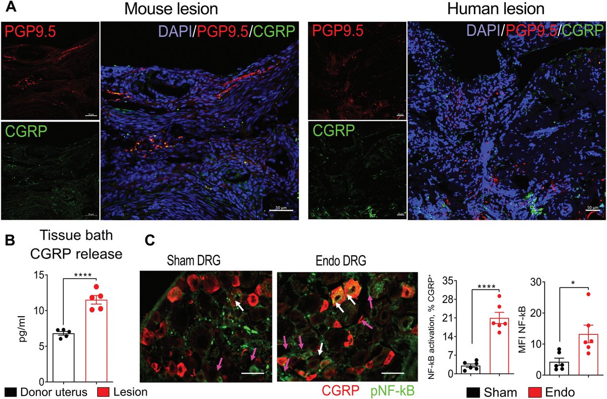 Waggoner Lab (@labwaggoner) on Twitter photo Blocking nociceptor CGRP to RAMP1 signaling in macrophages reduces endometriosis pain and lesion growth in a mouse model of the disease <a href="/ScienceTM/">Science Translational Medicine</a> <a href="/victor_fattori/">Victor Fattori 🚩</a>
science.org/doi/10.1126/sc… Blocking nociceptor CGRP to RAMP1 signaling in macrophages reduces endometriosis pain and lesion growth in a mouse model of the disease <a href="/ScienceTM/">Science Translational Medicine</a> <a href="/victor_fattori/">Victor Fattori 🚩</a>
science.org/doi/10.1126/sc…
