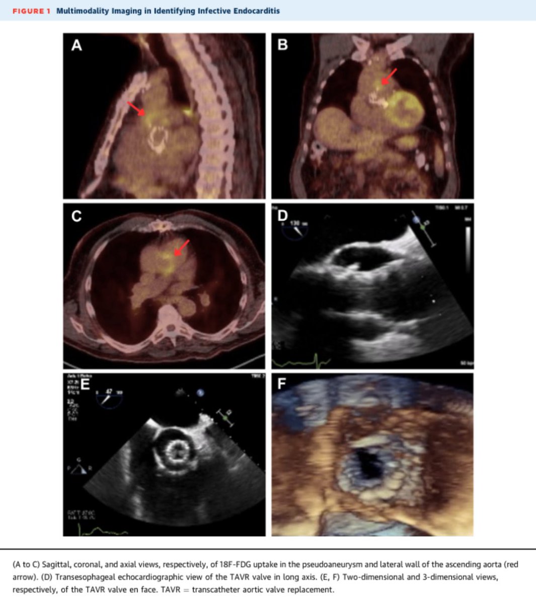 Akiva Rosenzveig (@akivarosenzveig) on Twitter photo Check out our case report just published in <a href="/JACCJournals/">JACC Journals</a> #JACCCaseReports highlighting the utility of PET imaging in when echocardiography falls short. I am so grateful for the mentorship of <a href="/GrantReedMD/">Grant Reed</a>
<a href="/CleClinicHVTI/">Cleveland Clinic Heart, Vascular & Thoracic</a> <a href="/CCF_IMCHIEFS/">Cleveland Clinic IM</a>
jacc.org/doi/10.1016/j.… Check out our case report just published in <a href="/JACCJournals/">JACC Journals</a> #JACCCaseReports highlighting the utility of PET imaging in when echocardiography falls short. I am so grateful for the mentorship of <a href="/GrantReedMD/">Grant Reed</a>
<a href="/CleClinicHVTI/">Cleveland Clinic Heart, Vascular & Thoracic</a> <a href="/CCF_IMCHIEFS/">Cleveland Clinic IM</a>
jacc.org/doi/10.1016/j.…