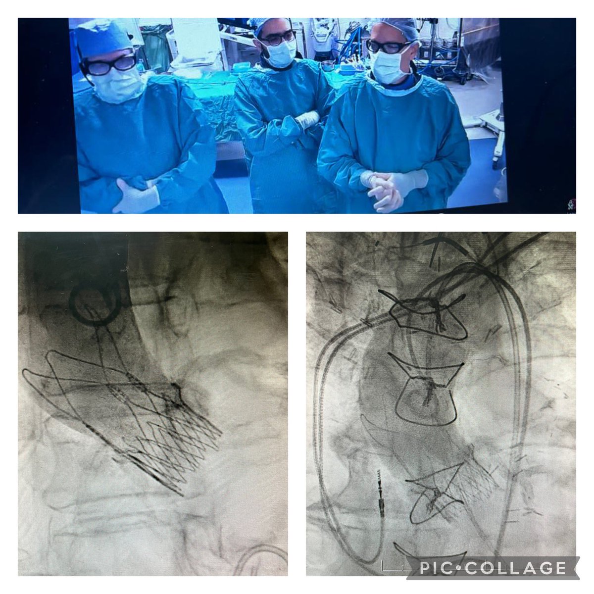 Ignacio Seropian MD (@iseropianmd) on Twitter photo Today at <a href="/imedCV/">IMedCV Hospital Italiano</a> we did 2 interest #TAVR cases:
1) TAVR + PCI that requiere extra support Wire + NC 🎈 for curve + 🦴
Case 🎥📡 to 🇫🇷 <a href="/MTC_Rouen/">MTC Rouen</a>
2) TAVR+Sentinel w/local IC 👩🏻⚕️👨🏻⚕️
Great to work in an amazing team <a href="/CMGarmendia/">Cristian M. Garmendia MD 🇦🇷</a> <a href="/sebapinel/">Sebastián Piñel</a> <a href="/GiulianaCorna/">Giuliana Corna MD</a> led by <a href="/carlaagatiello1/">carlaagatiello</a> Today at <a href="/imedCV/">IMedCV Hospital Italiano</a> we did 2 interest #TAVR cases:
1) TAVR + PCI that requiere extra support Wire + NC 🎈 for curve + 🦴
Case 🎥📡 to 🇫🇷 <a href="/MTC_Rouen/">MTC Rouen</a>
2) TAVR+Sentinel w/local IC 👩🏻⚕️👨🏻⚕️
Great to work in an amazing team <a href="/CMGarmendia/">Cristian M. Garmendia MD 🇦🇷</a> <a href="/sebapinel/">Sebastián Piñel</a> <a href="/GiulianaCorna/">Giuliana Corna MD</a> led by <a href="/carlaagatiello1/">carlaagatiello</a>