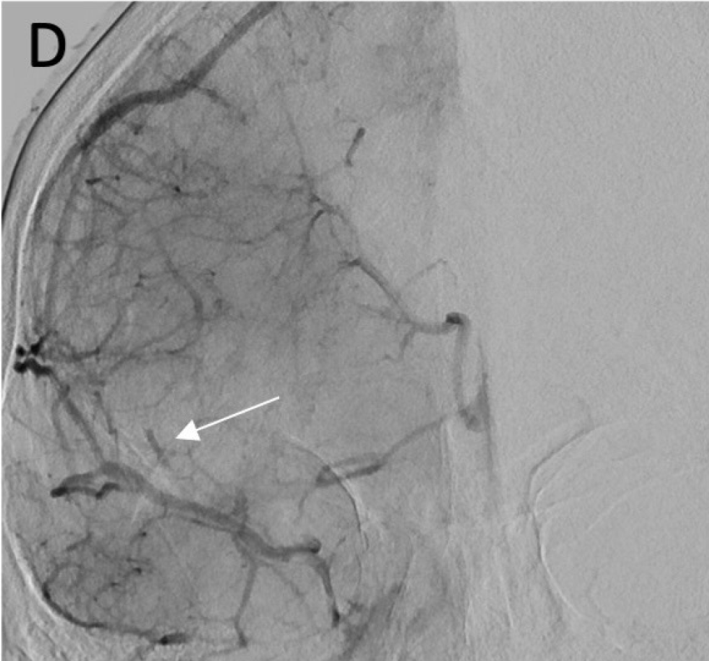 JNIS (@jnis_bmj) on Twitter photo Which technique do you use for EVT? Stent retriever? Contact aspiration? This case-control study from 🇫🇷 demonstrates that iatrogenic embolic events are less when stent-retrievers are involved. <a href="/toobib3/">Kevin JANOT</a> Link: bit.ly/3YB0gsK Which technique do you use for EVT? Stent retriever? Contact aspiration? This case-control study from 🇫🇷 demonstrates that iatrogenic embolic events are less when stent-retrievers are involved. <a href="/toobib3/">Kevin JANOT</a> Link: bit.ly/3YB0gsK