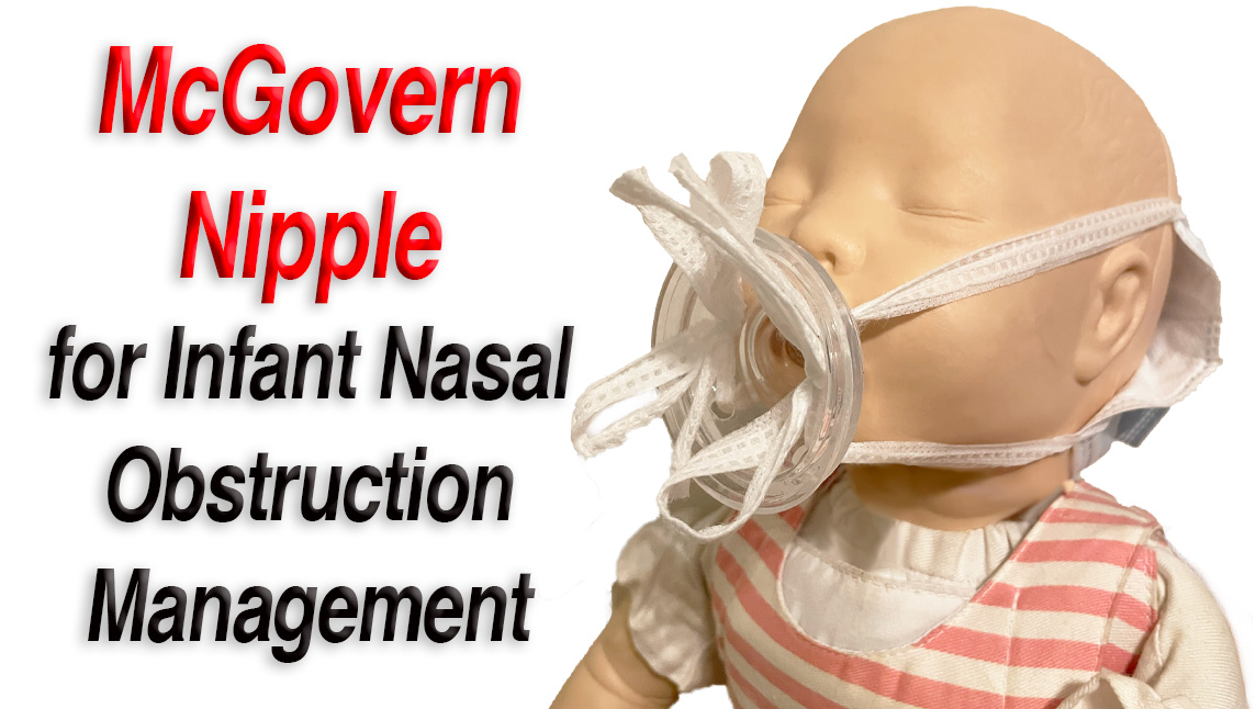 McGovern Nipple to Treat Infant Nasal Obstruction youtu.be/Df_mB-S-zjo