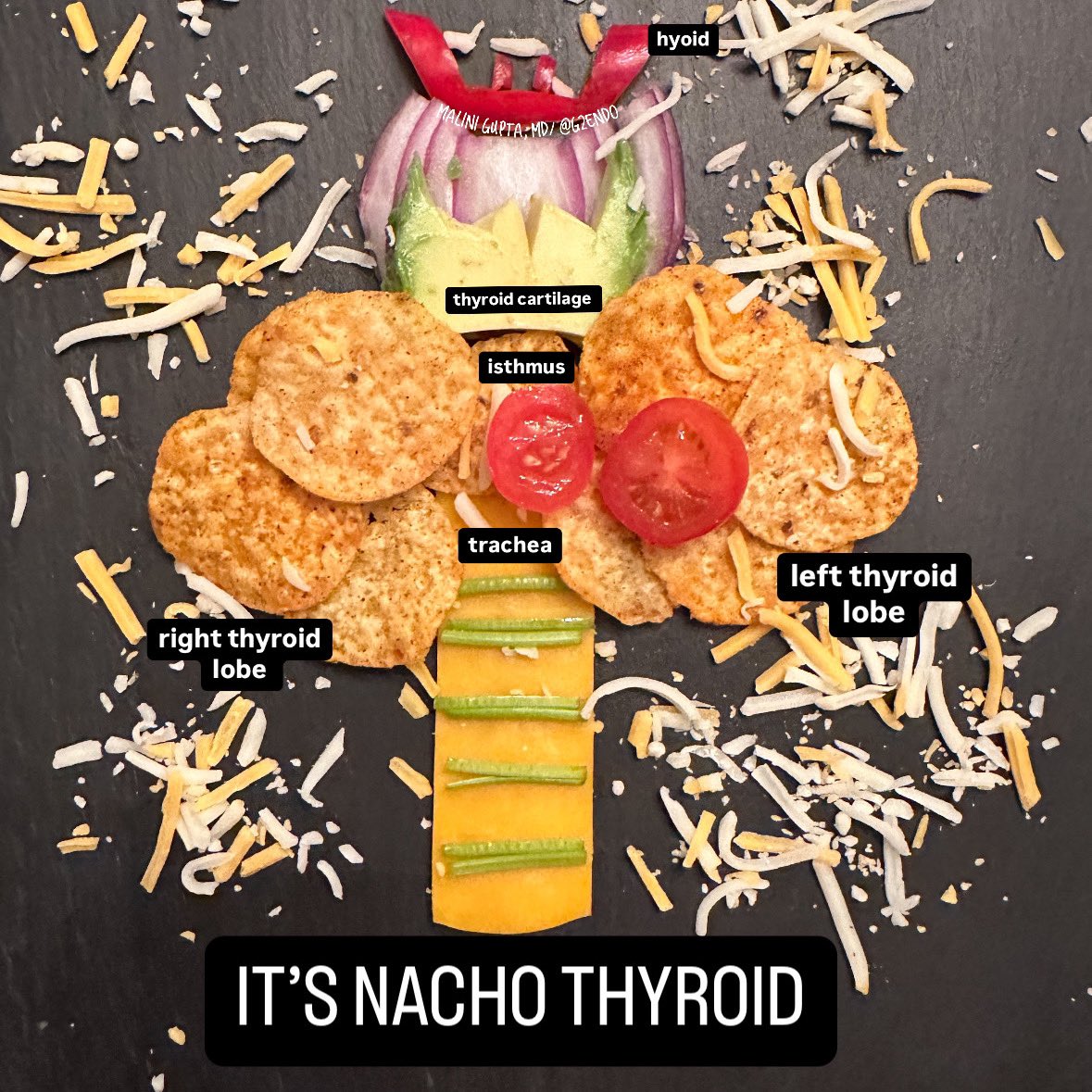 Malini Gupta, MD, FACE, ECNU (@maliniguptamd) on Twitter photo Happy #NationalNachoDay !   Sometimes there is unnecessary thyroid hormone lab testing , when the problem is “not your thyroid.”  #thyroid #endocrinology Happy #NationalNachoDay !   Sometimes there is unnecessary thyroid hormone lab testing , when the problem is “not your thyroid.”  #thyroid #endocrinology