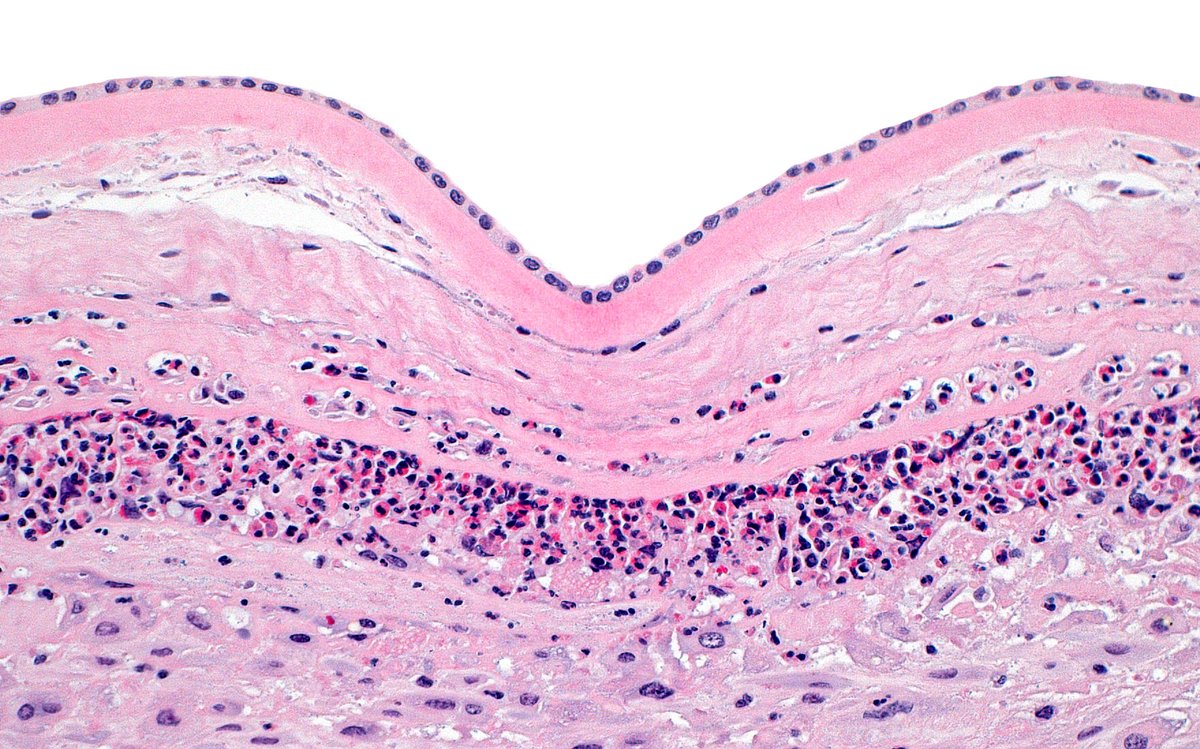 ziad_zaatari's tweet image. 🔬 Acute Chorioamnionitis ~ #Placenta #PediPath #Pathology