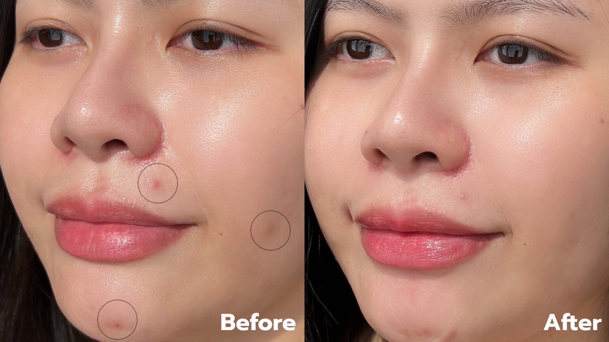 Nananblogblog's tweet image. รู้ละทำไมฝรั่งชอบตัวนี้กันเยอะ AXIS-Y ดาร์ก สปอต เซรั่ม จะไม่ไวรัลได้ไงจัดเต็มทั้ง Niacinamide ถึง 5% และมี Rice Bran ลดรอยดำสิวดีมากกกกกกก ช่วยปลอมประโลมผิว ใช้กับพวกยาสิวได้สบายๆ เนื้อเบาไม่หนักหน้า ไม่หนึบผิว รอดกับอากาศบ้านเราเว่อร์
#axisy  #เซรั่มรอยดำ #รอยสิว