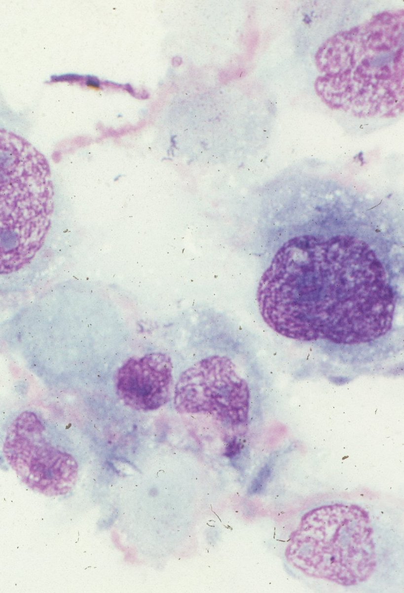 Burkitt. a documentary film. tweet media