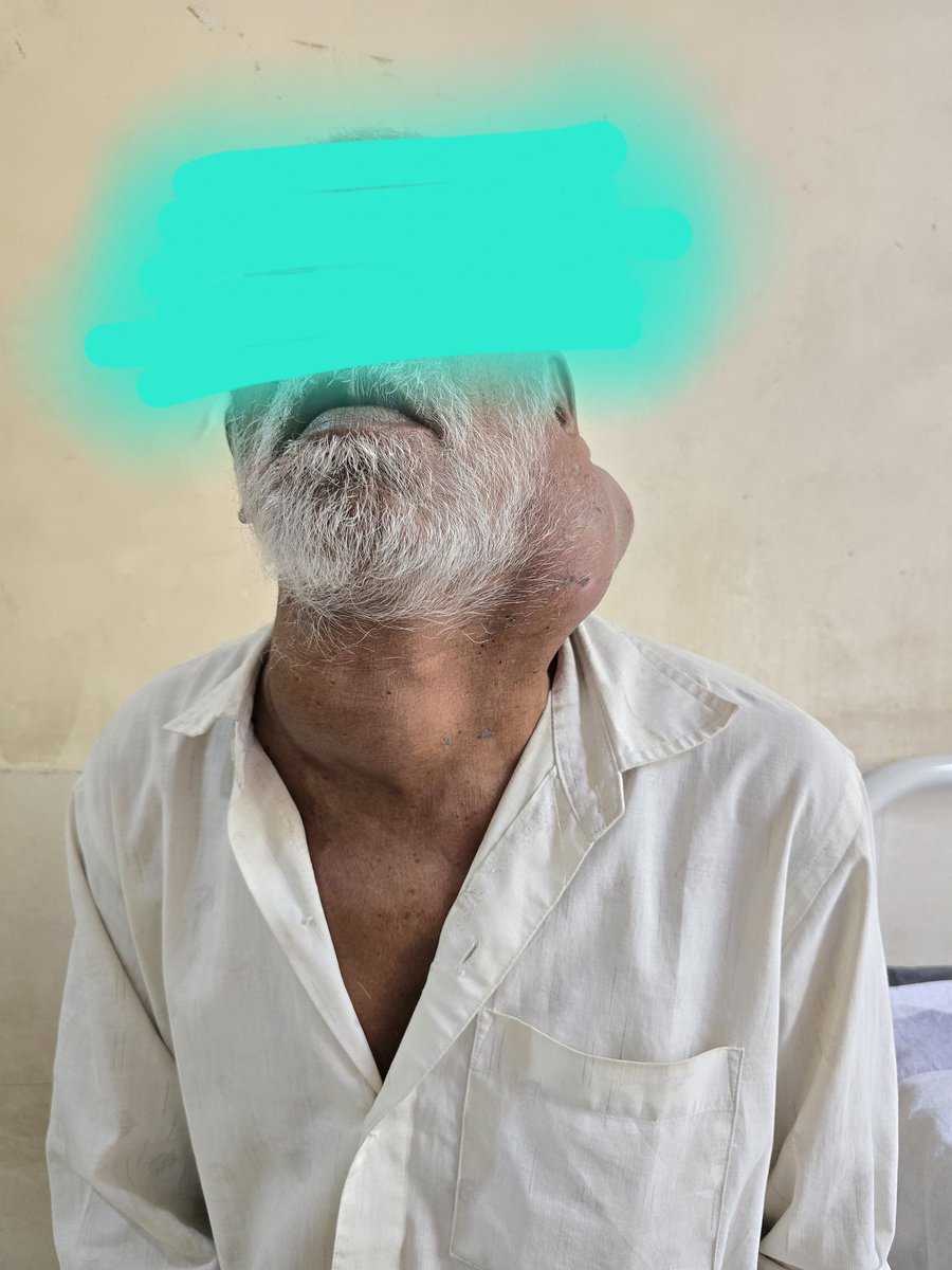 Sanjay k Yadav MCh, FACS, FSSO tweet media