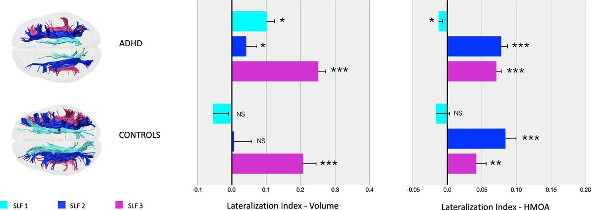new article alert:
Parlatini et al. show that all three branches of the superior longitudinal fascicle are strongly lateralized in adults with ADHD. Structural alterations are linked to clinical signs
rdcu.be/dZqOt
<a href="/KingsIoPPN/">Institute of Psychiatry, Psychology & Neuroscience</a>