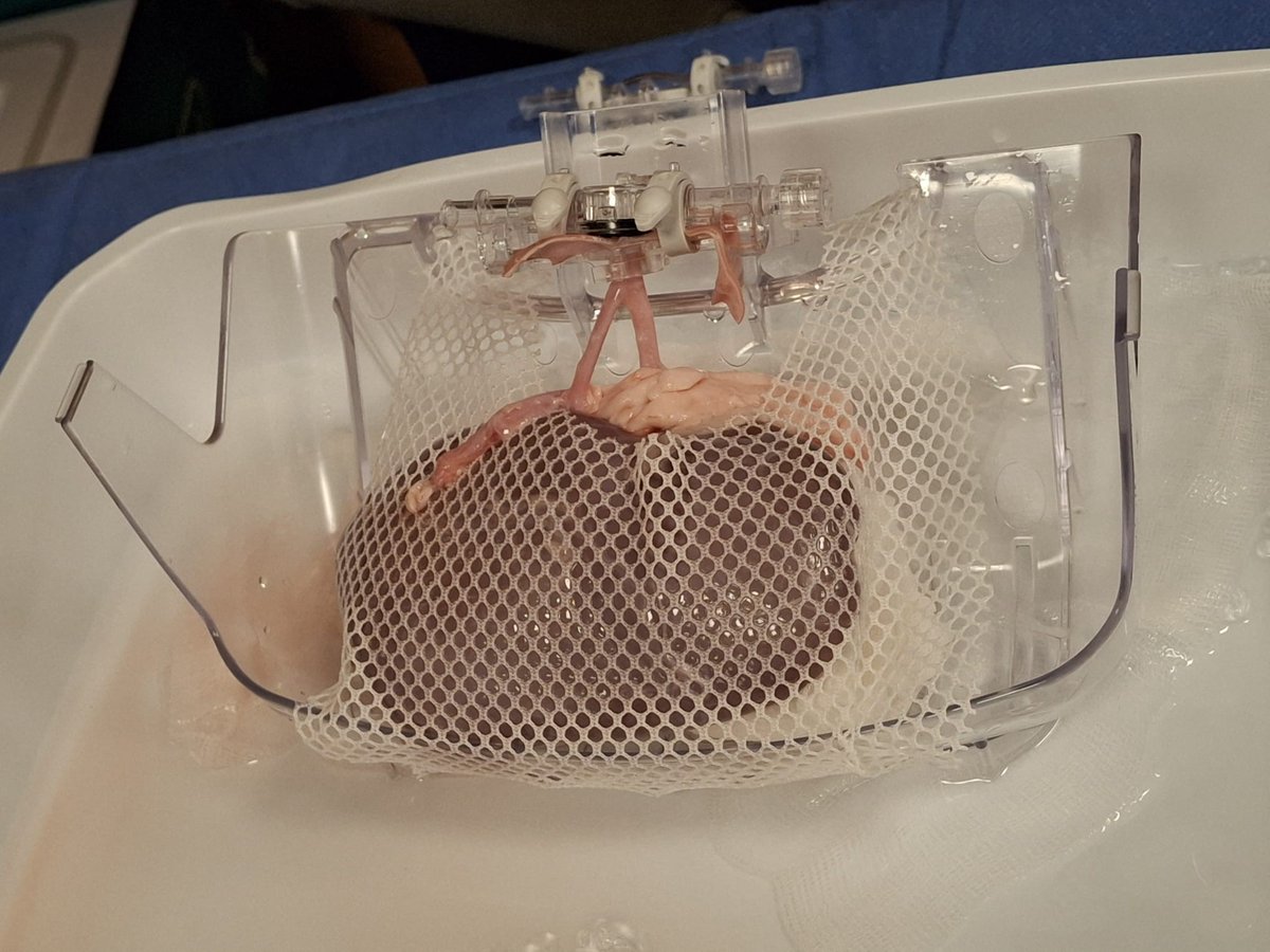 PedNephParis_RD's tweet photo. 🔴 [Réunion sur la Perfusion de Greffons Rénaux en Pédiatrie] :

👨‍⚕️ Place à l'atelier pratique "avec la préparation du LifePort, canulation et gestion d'un rein en perfusion".

Sur l'image le Dr Amane LACHKAR (chirurgie pédiatrique)

#nephrologie #greffe #lifeport #pediatrie https://t.co/ePzvXrzMEX