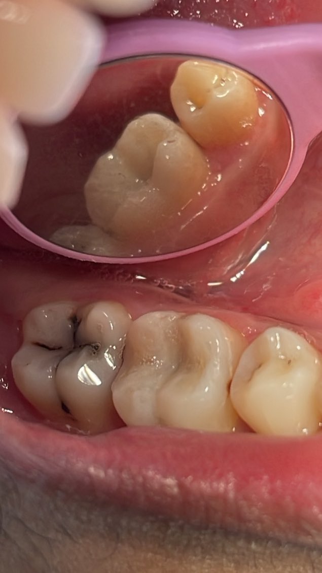 # 46 
Class I occlusal
+Buccal pit