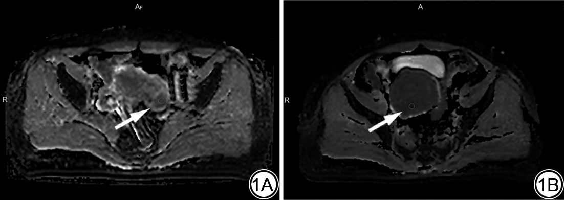 CJMRI_2010's tweet photo. The combined model constructed by #ADCmin and clinical and imaging features can effectively predict the clinical efficacy of #HIFU in the treatment of uterine fibroids, and can offer valuable insights for formulating clinical treatment strategies.
https://t.co/1GA43uujwU https://t.co/Su6Sjio4sQ