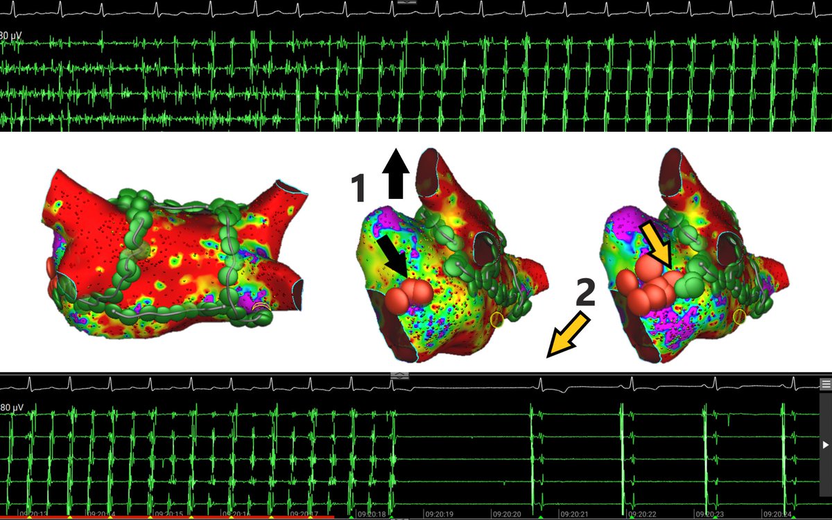 Michail Efremidis (@mefraimidis) on Twitter photo LSAF more than 2 years converted into SR during MI ablation using AFFERA system. AF to MFL and then to SR@SteliosDragasis <a href="/ipetemil/">Panagiotis Mililis</a> <a href="/athsaplaouras/">Athanasios Saplaouras</a> <a href="/Kariki_O/">Ourania Kariki</a> <a href="/K_Letsas/">Konstantinos Letsas</a> @PetrosSkalidis@Medtronic LSAF more than 2 years converted into SR during MI ablation using AFFERA system. AF to MFL and then to SR@SteliosDragasis <a href="/ipetemil/">Panagiotis Mililis</a> <a href="/athsaplaouras/">Athanasios Saplaouras</a> <a href="/Kariki_O/">Ourania Kariki</a> <a href="/K_Letsas/">Konstantinos Letsas</a> @PetrosSkalidis@Medtronic