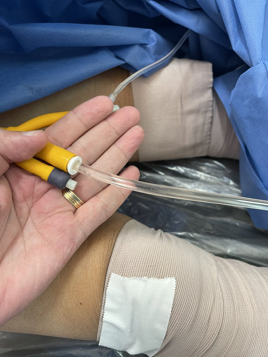 Lucas Yirula (@lucas_yirula) on Twitter photo Great demonstration by <a href="/MartinCKanne/">Martin Kanne</a> at @urovivo24 performing a #Holep with early apical release. Thanks for sharing your tips and tricks. 👏 <a href="/astridreinke/">Astrid Reinke</a> <a href="/SurgicalJena/">JenaSurgical</a> Great demonstration by <a href="/MartinCKanne/">Martin Kanne</a> at @urovivo24 performing a #Holep with early apical release. Thanks for sharing your tips and tricks. 👏 <a href="/astridreinke/">Astrid Reinke</a> <a href="/SurgicalJena/">JenaSurgical</a>