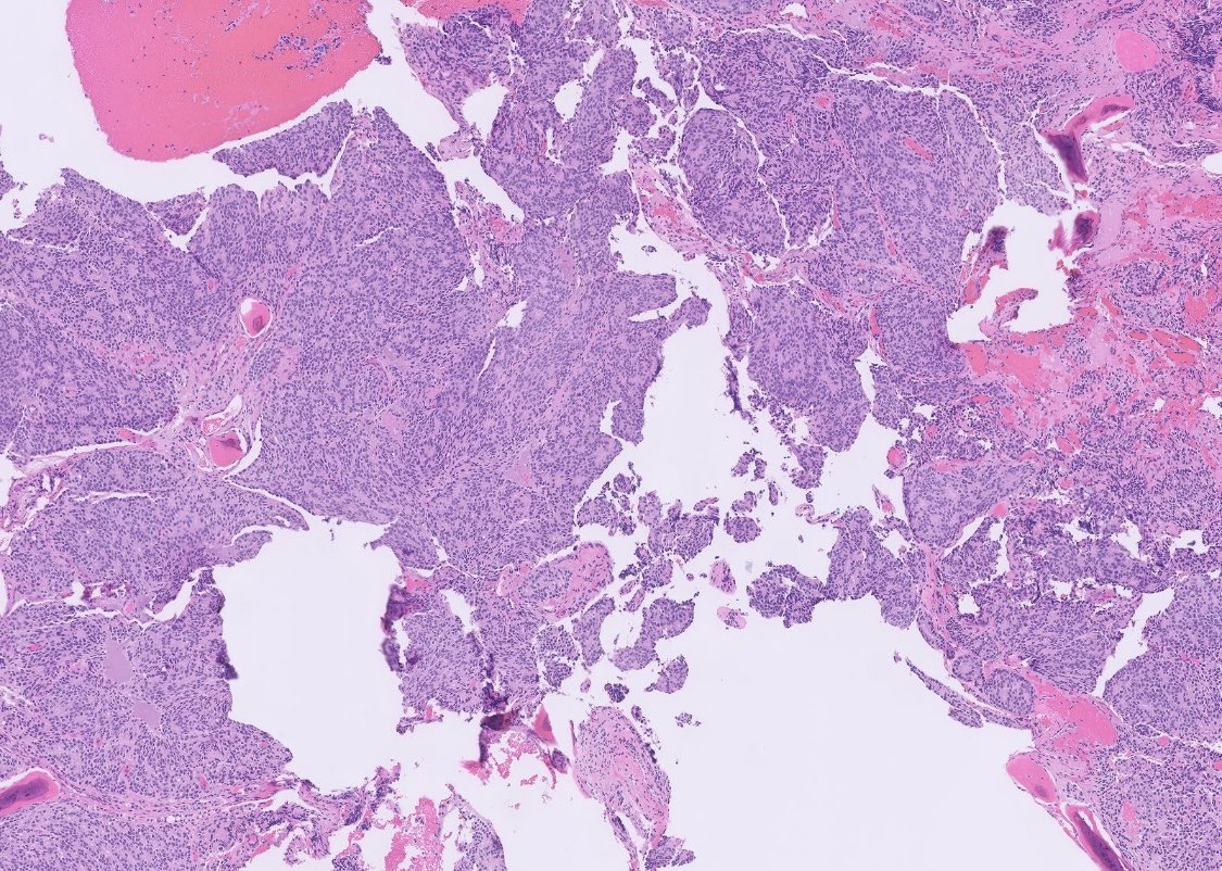 PeterKobalka's tweet image. This spine mass was submitted as “rule out ependymoma.”  Thoughts? Stains? Dx?  #cnspath #neuropath #neuropathology #pathx #pathtwitter