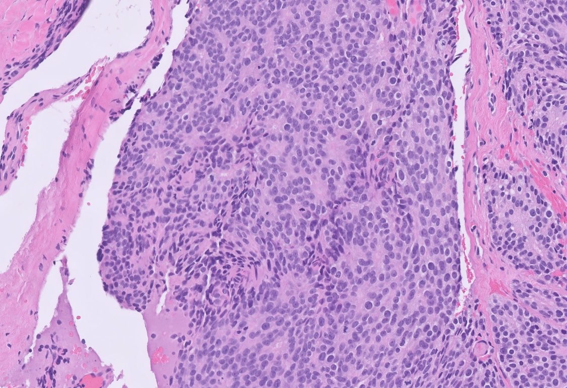 PeterKobalka's tweet image. This spine mass was submitted as “rule out ependymoma.”  Thoughts? Stains? Dx?  #cnspath #neuropath #neuropathology #pathx #pathtwitter