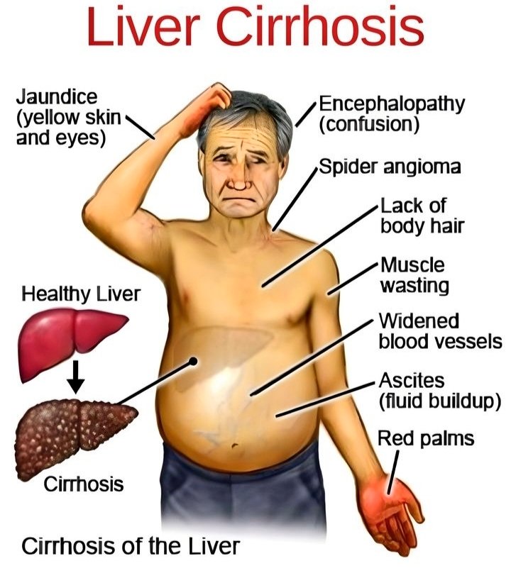 🔴Liver cirrhosis manifestations by Medquizzing