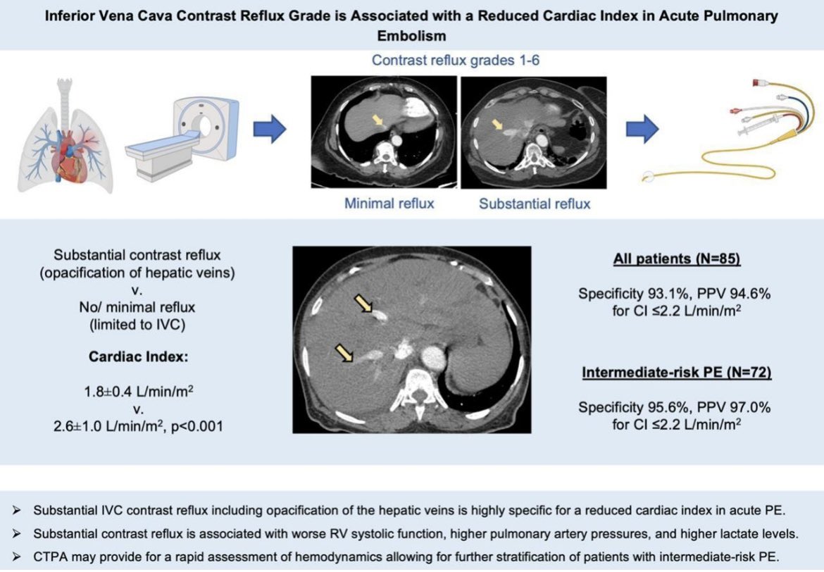 NYULangonePCCSM (@nyulangonepccsm) on Twitter photo A multidisciplinary team from <a href="/BellevueHosp/">NYC Health + Hospitals/Bellevue</a> + <a href="/nyulangone/">NYU Langone Health</a> demonstrates that IVC contrast reflux grade is highly specific for predicting a reduced cardiac index in patients with acute PE in <a href="/ThrombosisRese1/">Thrombosis Research</a>
🔓 bit.ly/3YcjSmP
#PulmonaryEmbolism #PCCM #CriticalCare #PERT A multidisciplinary team from <a href="/BellevueHosp/">NYC Health + Hospitals/Bellevue</a> + <a href="/nyulangone/">NYU Langone Health</a> demonstrates that IVC contrast reflux grade is highly specific for predicting a reduced cardiac index in patients with acute PE in <a href="/ThrombosisRese1/">Thrombosis Research</a>
🔓 bit.ly/3YcjSmP
#PulmonaryEmbolism #PCCM #CriticalCare #PERT