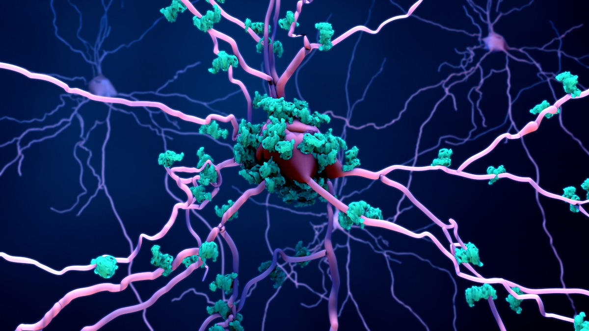Yale School of Medicine (@yalemed) on Twitter photo In a recent study, <a href="/NeurologyYale/">Yale Neurology</a> researchers use new techniques to study human brains impacted by #ParkinsonsDisease in unprecedented detail, revealing increased #inflammation in the #brains of people with Parkinson’s: brnw.ch/21wOs34 In a recent study, <a href="/NeurologyYale/">Yale Neurology</a> researchers use new techniques to study human brains impacted by #ParkinsonsDisease in unprecedented detail, revealing increased #inflammation in the #brains of people with Parkinson’s: brnw.ch/21wOs34