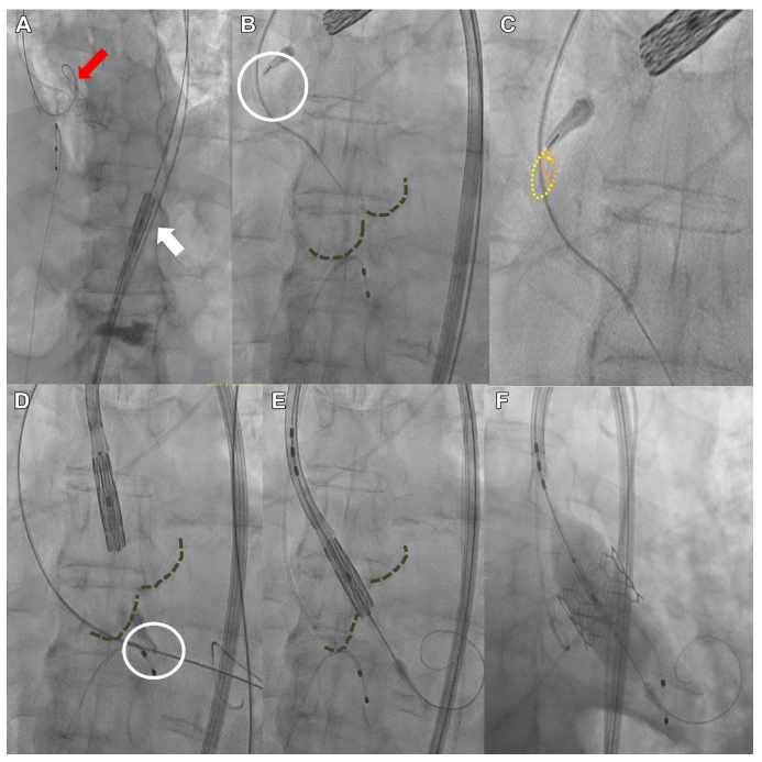 Gennaro Giustino, MD (@g_giustinomd) on Twitter photo Great technique to bail-out lost wire position in the LV during balloon-expandable TAVR using a 4-8 mm EN-snare through the delivery system. Nice! <a href="/ryankaple/">Ryan K. Kaple MD</a> <a href="/CraigBasman/">Craig Basman, MD, FACC, FSCAI</a>
A Microsnare Technique for Transcatheter Heart Valve Recrossing After Inadvertent Wire Withdrawal From Left Great technique to bail-out lost wire position in the LV during balloon-expandable TAVR using a 4-8 mm EN-snare through the delivery system. Nice! <a href="/ryankaple/">Ryan K. Kaple MD</a> <a href="/CraigBasman/">Craig Basman, MD, FACC, FSCAI</a>
A Microsnare Technique for Transcatheter Heart Valve Recrossing After Inadvertent Wire Withdrawal From Left