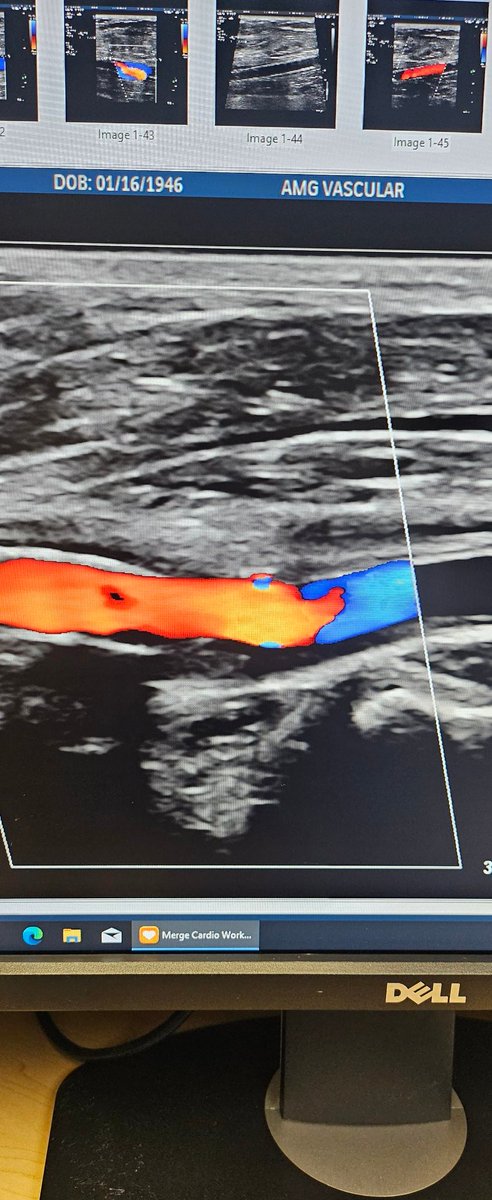 Jaafer Golzar MD FACC, FSCAI (@jaafgolzar) on Twitter photo First glimpse of #PTAB w #Detour <a href="/endologix/">Endologix</a> 3 week surveillance arterial duplex <a href="/ShawnPenn33/">Shawn Penn</a> <a href="/DeanFerreraDO/">Dean Ferrera</a> <a href="/MarcoShaker/">Marco Shaker</a> <a href="/kymbee/">Kym McNicholas | Emmy Award-Winning Journalist</a> <a href="/tlevin/">Tom Levin, MD</a> First glimpse of #PTAB w #Detour <a href="/endologix/">Endologix</a> 3 week surveillance arterial duplex <a href="/ShawnPenn33/">Shawn Penn</a> <a href="/DeanFerreraDO/">Dean Ferrera</a> <a href="/MarcoShaker/">Marco Shaker</a> <a href="/kymbee/">Kym McNicholas | Emmy Award-Winning Journalist</a> <a href="/tlevin/">Tom Levin, MD</a>