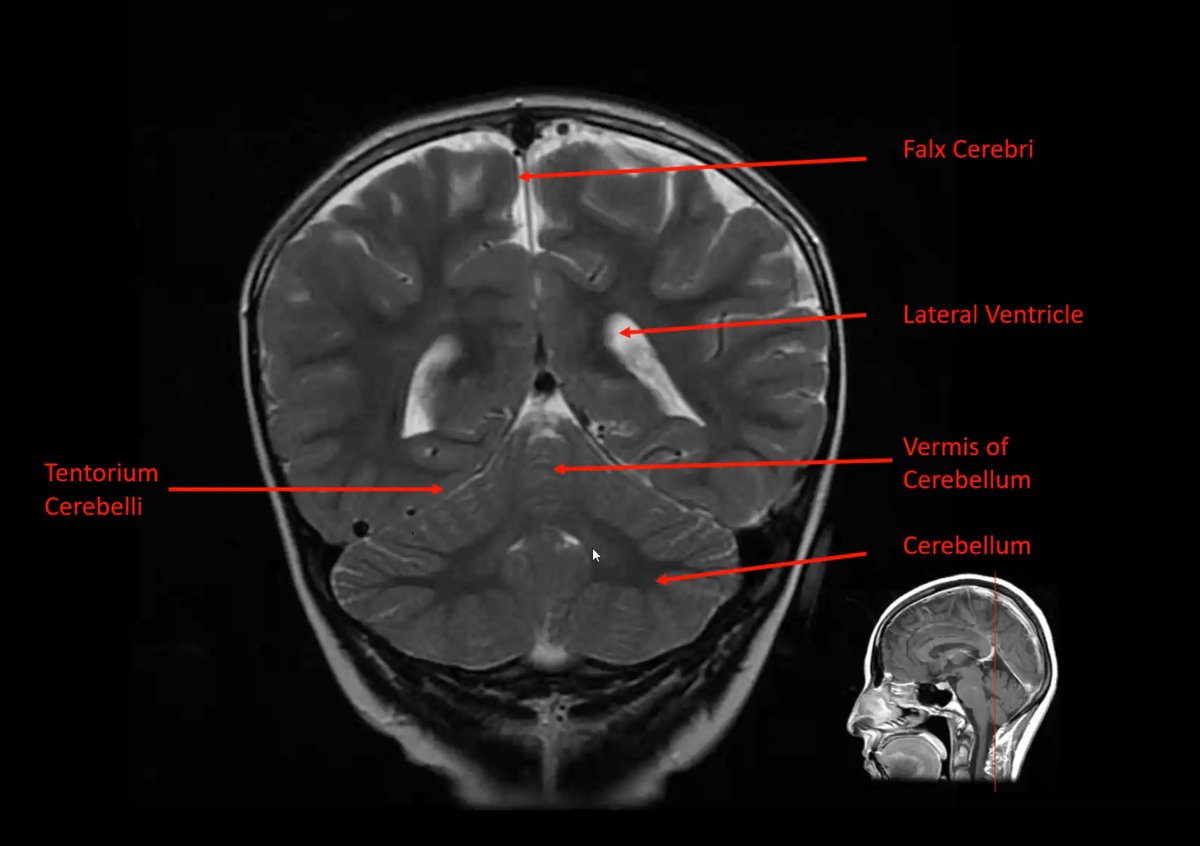 MariamAboian's tweet photo. Excellent learning pearls on MRI Anatomy of the Brain!!! @BraTS_challenge @BraTS_Mets_2025 @BrookeSchrickel @OSURadiology Thank you Dr. Schrickel!!! https://t.co/HZBI1G7jr1