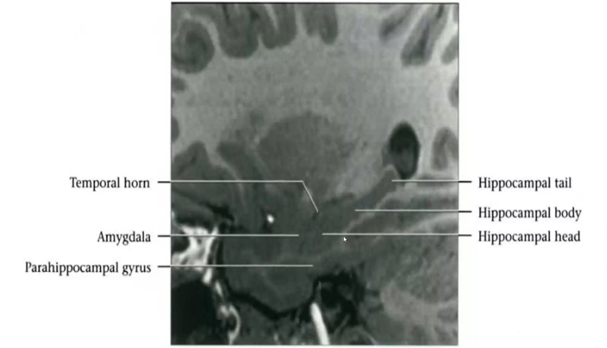 Mariam Aboian (@mariamaboian) on Twitter photo Excellent learning pearls on MRI Anatomy of the Brain!!! <a href="/BraTS_challenge/">BraTS</a> <a href="/BraTS_Mets_2025/">BraTS 2025 Lighthouse Challenge</a> <a href="/BrookeSchrickel/">Brooke Schrickel</a> <a href="/OSURadiology/">Ohio State Radiology</a> Thank you Dr. Schrickel!!! Excellent learning pearls on MRI Anatomy of the Brain!!! <a href="/BraTS_challenge/">BraTS</a> <a href="/BraTS_Mets_2025/">BraTS 2025 Lighthouse Challenge</a> <a href="/BrookeSchrickel/">Brooke Schrickel</a> <a href="/OSURadiology/">Ohio State Radiology</a> Thank you Dr. Schrickel!!!