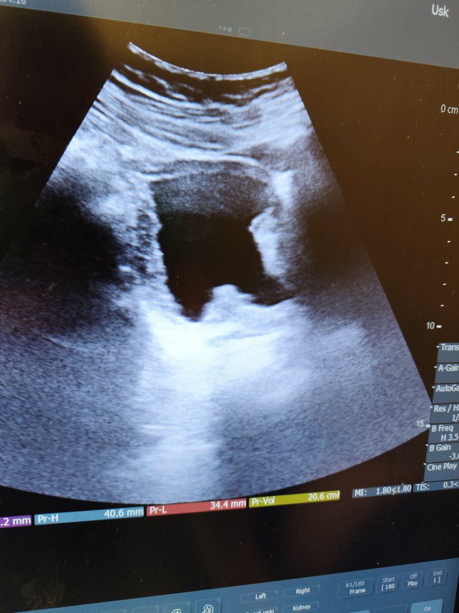 Łukasz Nowak (@lukasz_t_nowak) on Twitter photo 20th HoLEP procedure
90 ml
Enucleaction + morcellation = 60 min
Early apical release
Catheter removed 24h after procedure
Full continence
Full of gratitude to <a href="/wojciechpiotrk1/">wojciech_piotr_krajewski</a> for constant tutoring 20th HoLEP procedure
90 ml
Enucleaction + morcellation = 60 min
Early apical release
Catheter removed 24h after procedure
Full continence
Full of gratitude to <a href="/wojciechpiotrk1/">wojciech_piotr_krajewski</a> for constant tutoring