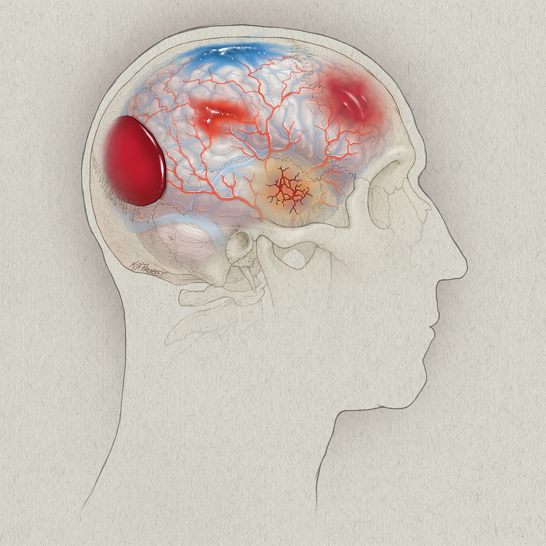 UCSF Neurosurgery (@neurosurgucsf) on Twitter photo In <a href="/LancetRH_Americ/">The Lancet Reg Health-Americas</a>, researchers characterize the clinical profile + outcomes of U.S. TBI patients with cranial surgery in the prospective, 18-center #TRACKTBI study, laying the groundwork for future analyses in targeted #TBI subgroups: sciencedirect.com/science/articl…
<a href="/JohnKYueMD/">John K. Yue, MD</a> In <a href="/LancetRH_Americ/">The Lancet Reg Health-Americas</a>, researchers characterize the clinical profile + outcomes of U.S. TBI patients with cranial surgery in the prospective, 18-center #TRACKTBI study, laying the groundwork for future analyses in targeted #TBI subgroups: sciencedirect.com/science/articl…
<a href="/JohnKYueMD/">John K. Yue, MD</a>