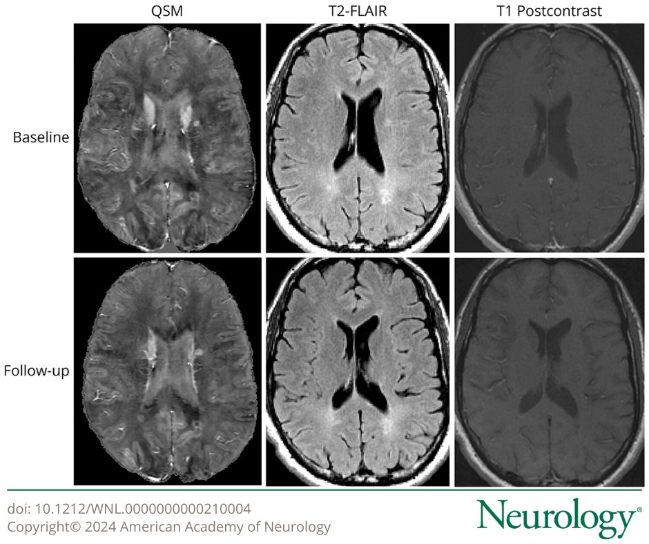 This study assessed the longitudinal associations between paramagnetic rim lesions (PRL) disappearance and new PRL appearance and clinical disability progression and brain atrophy. Learn more: bit.ly/3NU6hvF

#NeuroX #NeuroTwitter