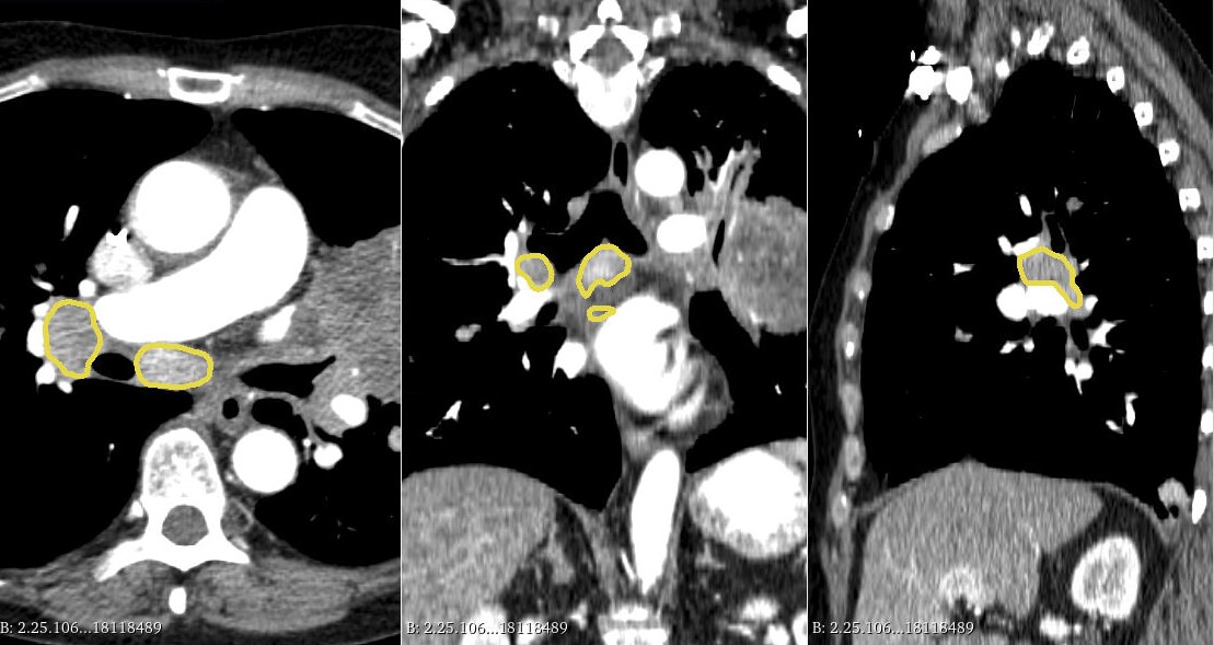 "Mediastinal-Lymph-Node-SEG" is now available at doi.org/10.7937/QVAZ-J…! It contains chest CT scans from 513 patients with lymphadenopathy due to illness, such as cancer or infections. Segmentations are also included to help develop new tools from weakly annotated cases.