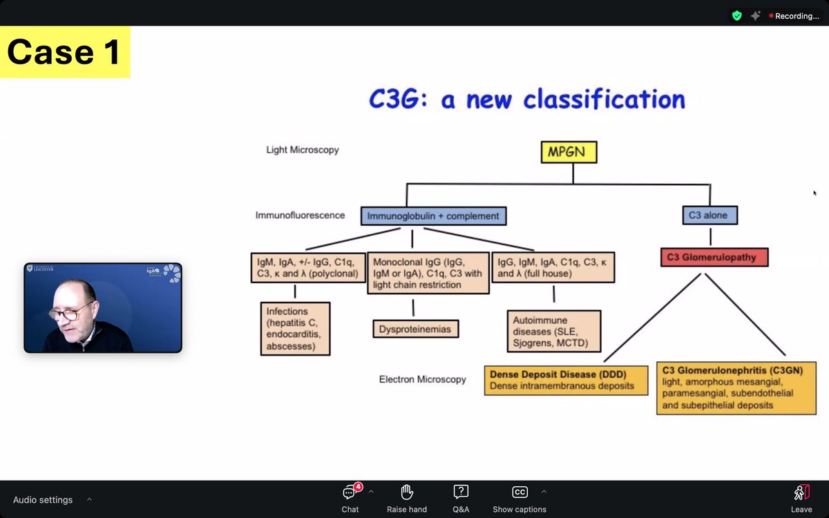 Noroژa (@n0r0zha) on Twitter photo Case-based discussions on
Glomerular Diseases
Teaching point from Case 1:
C3G does not always present with an MPGN pattern.
<a href="/IgAN_JBarratt/">Jonathan Barratt</a>
<a href="/UKKidney/">The UK Kidney Association</a>
<a href="/RenalSpRClub/">Renal SpR Club</a> Case-based discussions on
Glomerular Diseases
Teaching point from Case 1:
C3G does not always present with an MPGN pattern.
<a href="/IgAN_JBarratt/">Jonathan Barratt</a>
<a href="/UKKidney/">The UK Kidney Association</a>
<a href="/RenalSpRClub/">Renal SpR Club</a>