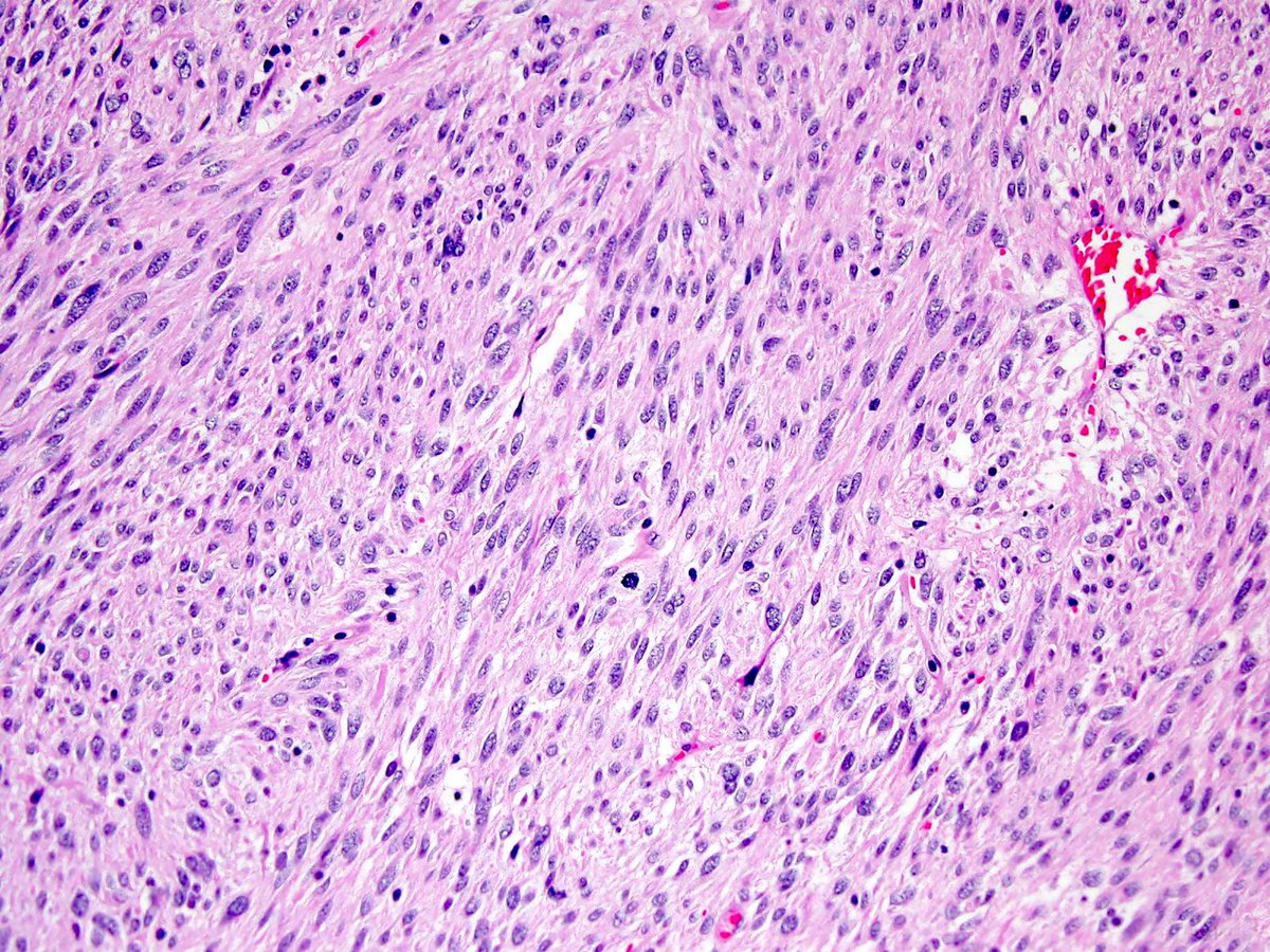 CuringN's tweet photo. Soft tissue - What's your diagnosis?
Topic link: https://t.co/JrjR8qtUvJ
Images contributed by Borislav A. Alexiev, M.D.
Visit our CCN blog for cancer-related essays by Dr. Pernick: https://t.co/aaLBk9B2jb.
#Cancer #CancerResearch #CuringCancerNetwork #Pathology https://t.co/s3dO5d4WP5