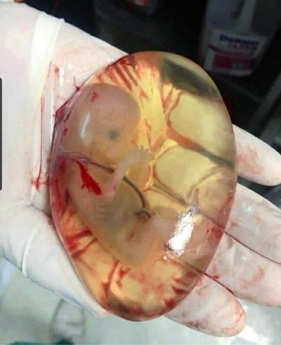 Expulsión del feto aún dentro de la membrana amniótica completamente intacta, debido a un aborto espontáneo.