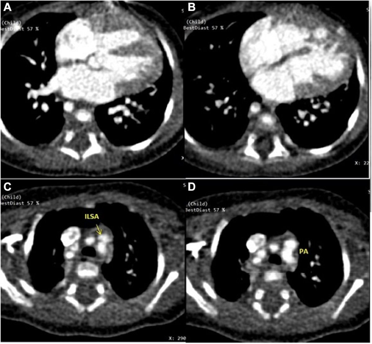 ✍️ In this #CaseReport, authors discuss the management of an infant with isolated left subclavian artery, multiple #VSD, and pulmonary hypertension 👉 cjcpc.ca/article/S2772-… #CJCPC #OpenAccess