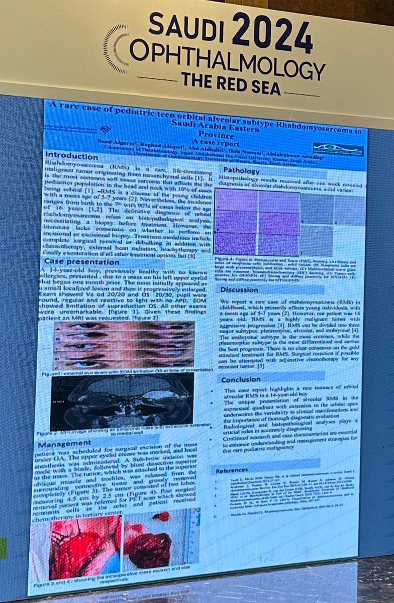 Glad and honored to have the opportunity to present our research paper and our case report at the Saudi Ophthalmology Society Conference. Special thanks to Dr. Abdulaziz Alsomali and Dr. Hala Nassem  for their kind supervision and support.  Also thanks to our great team! #SO2024
