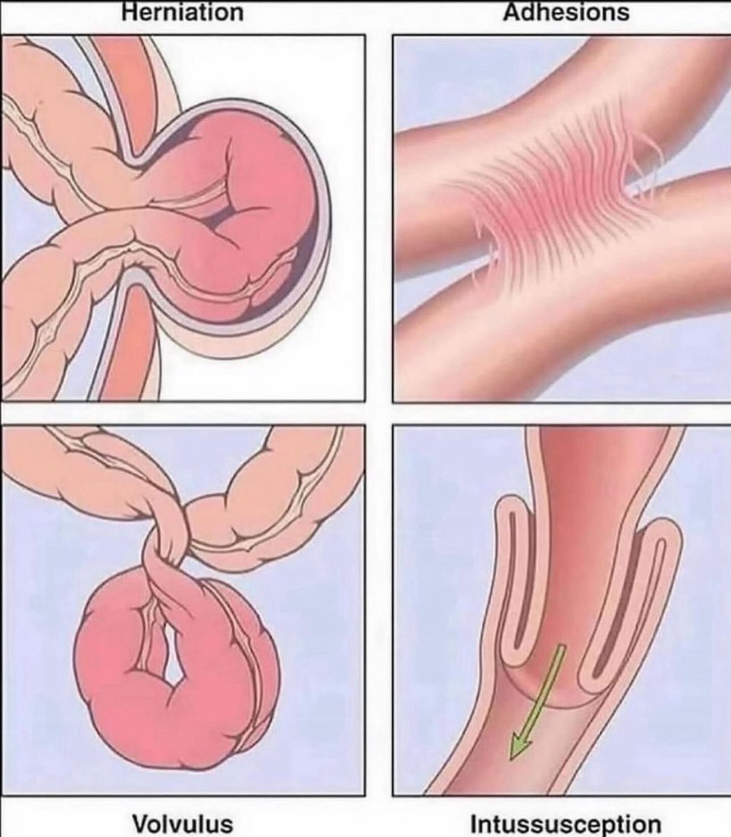 Causes of small bowel obstruction 💡