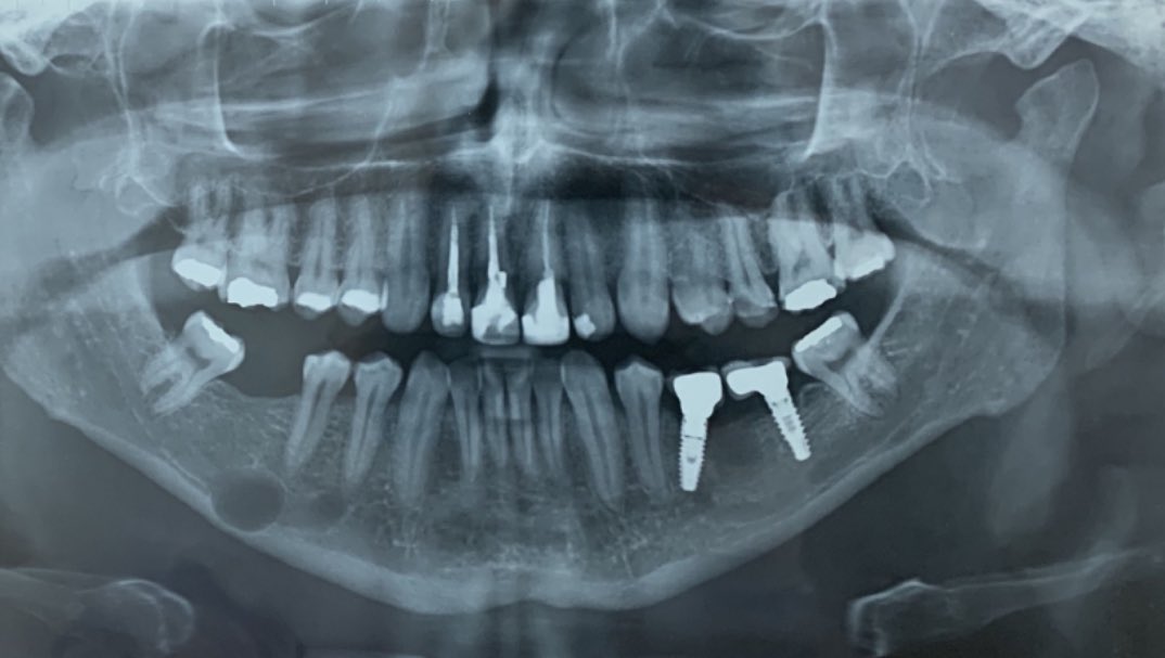 PenafortPaulo's tweet photo. A radiolucent mandibular lesion with a 5-year history.
S100(+), SOX-10(+), AML(-), H-Caldesmon(-), GLUT-1(-), Ki-67< 5%.
Diagnosis: Intraosseous schwannoma. We recently published four cases of intraosseous benign peripheral nerve sheath tumors in the jaws.
https://t.co/ENZZMnzRtb https://t.co/JgdqNPVoUo
