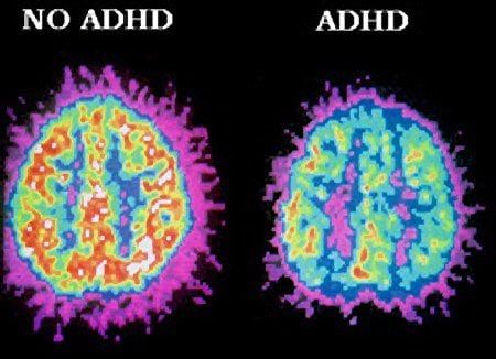 你被欺骗了。

多动症（ADHD）并不是一种可以通过吃药治愈的心理疾病。

它是一种超能力。

一旦你掌控它，你将变得无所不能。

以下是如何将 ADHD 转化为超能力的方法：🧵 https://t.co/8rLT6fBLAr